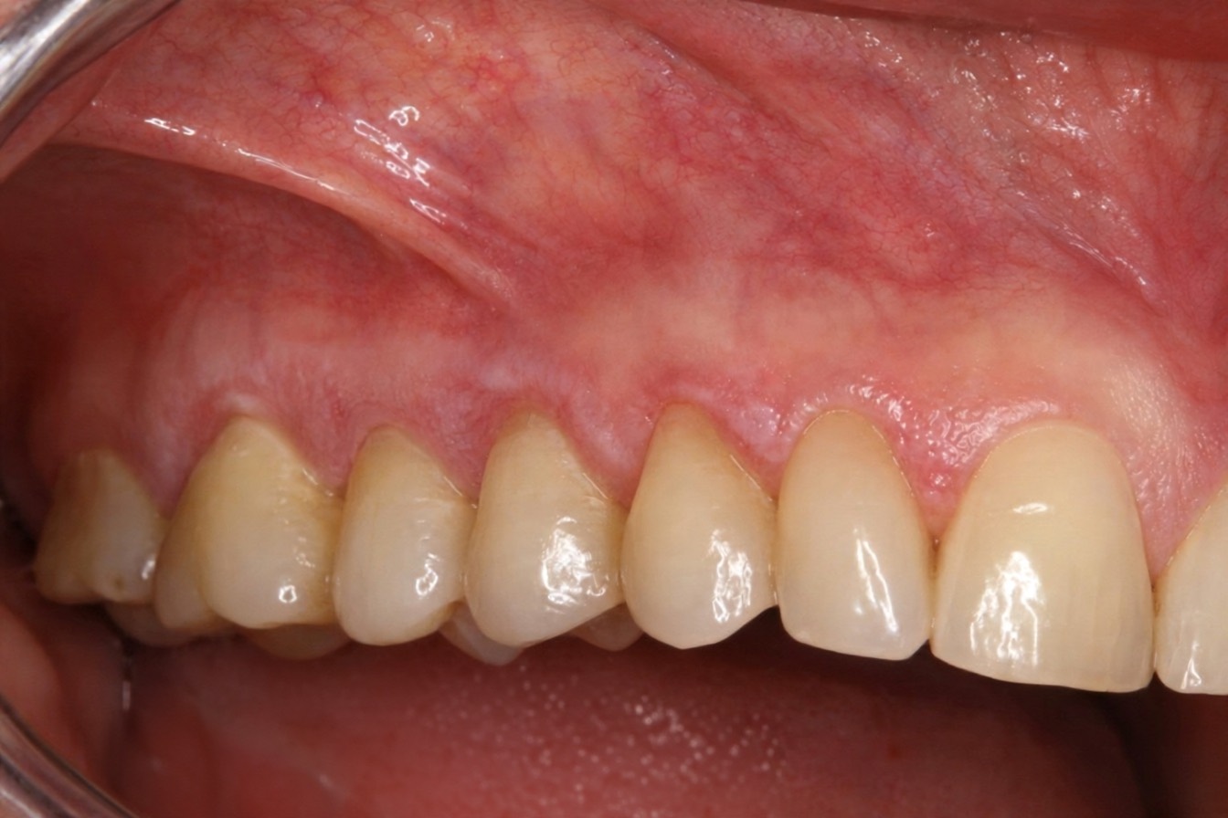 Veränderung der marginalen Gingiva